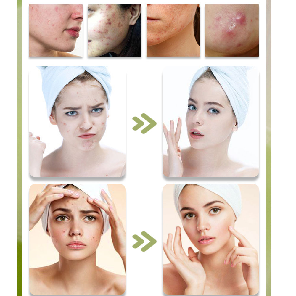 Kstim trattamento naturale del - Tea Tree Spot Treatment recensione e prezzo